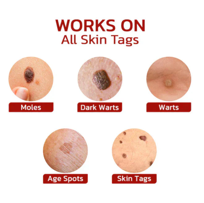 Wipe Off Tags and Mole Remover Pen